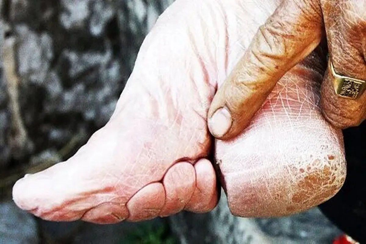 سنتی دردناک در چین برای پاها !+ عکس