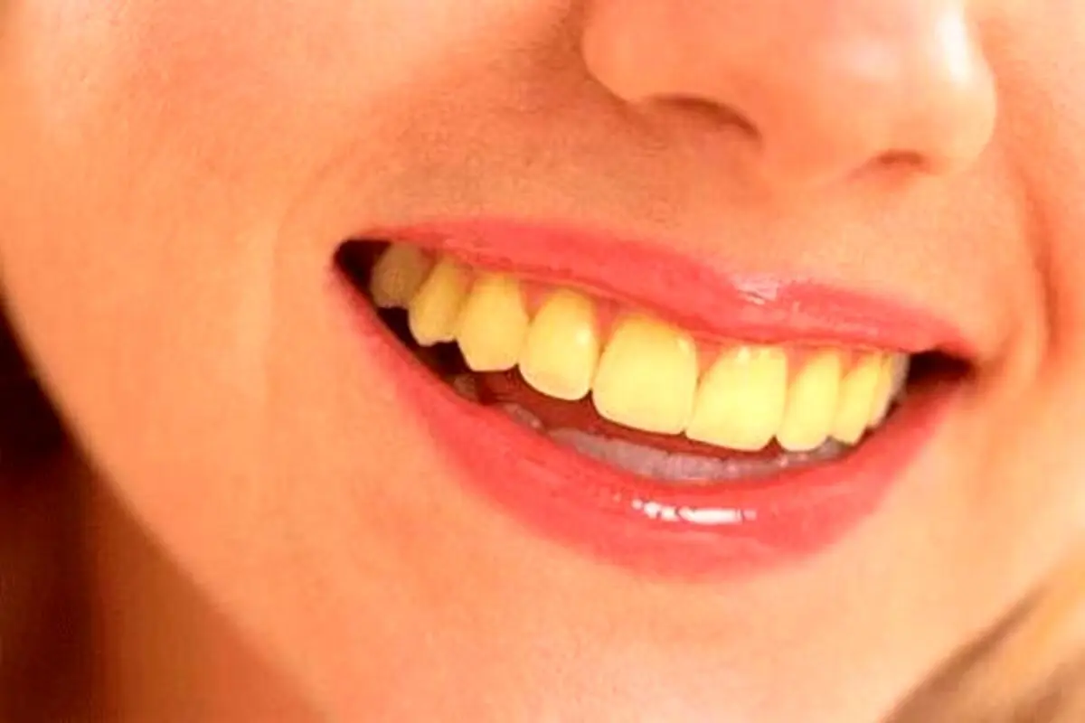 چگونه از زرد شدن دندان جلوگیری کنیم؟