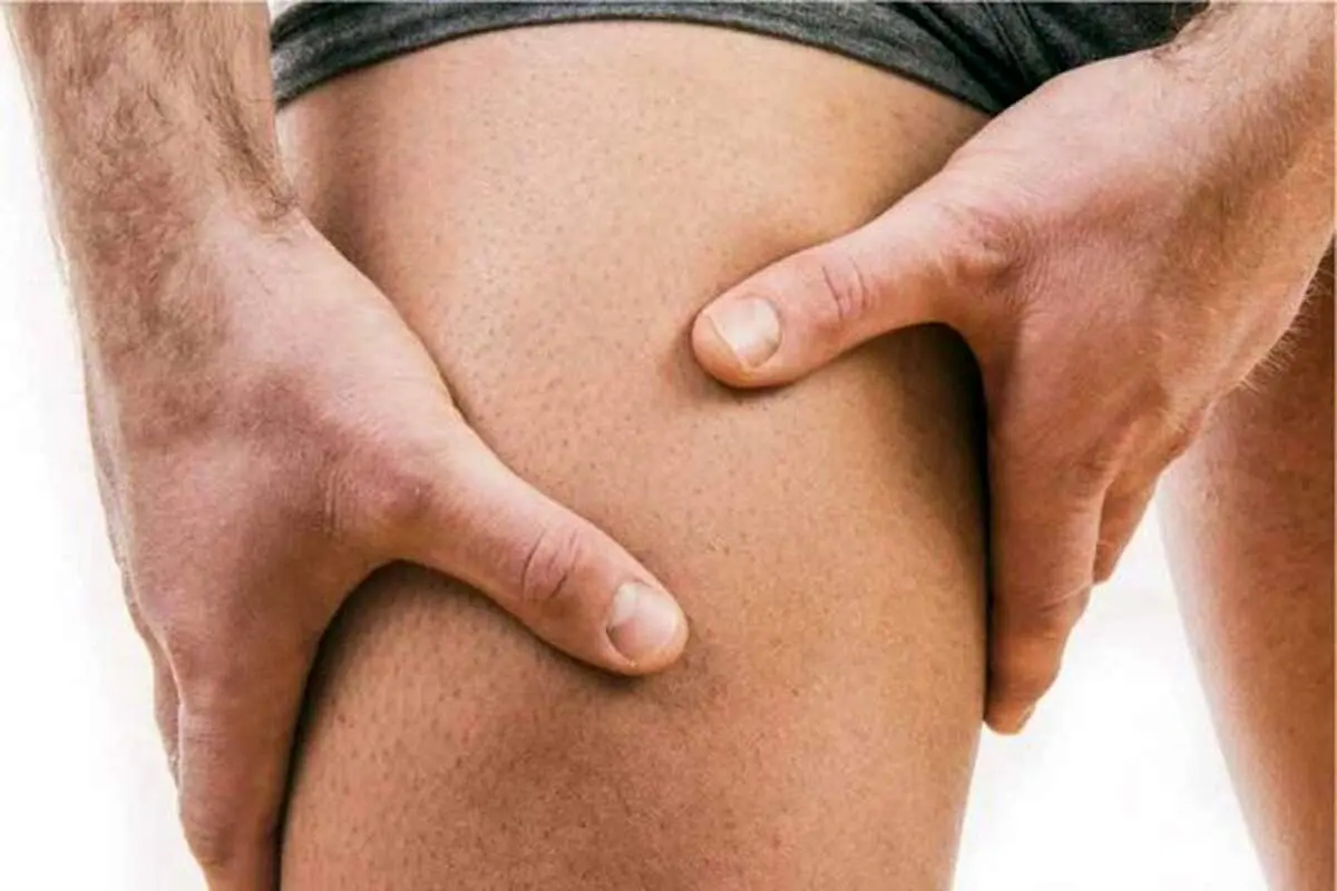 روش های خانگی برای از بین بردن سیاهی کشاله ران