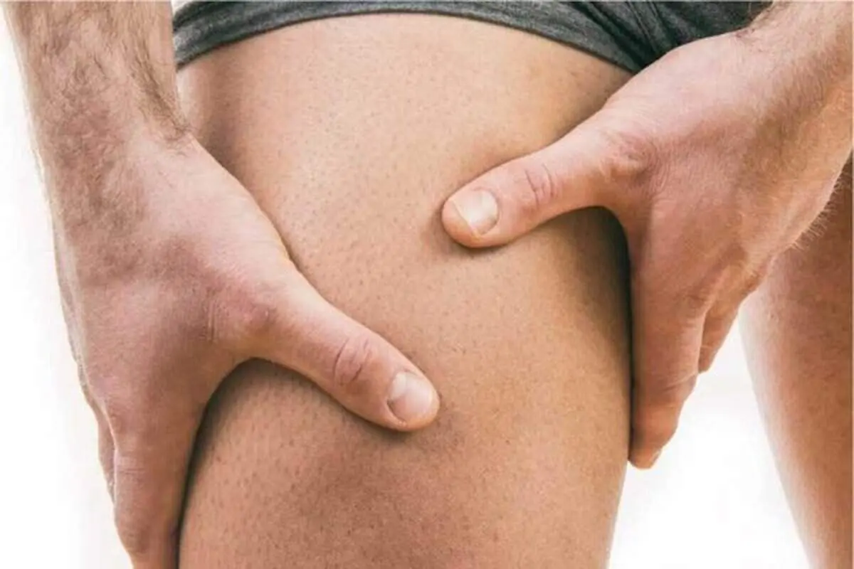روش های خانگی برای از بین بردن سیاهی کشاله ران