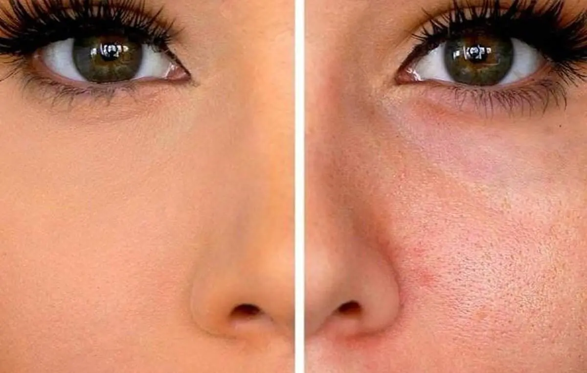 روشی قطعی برای درمان منافذ باز پوست