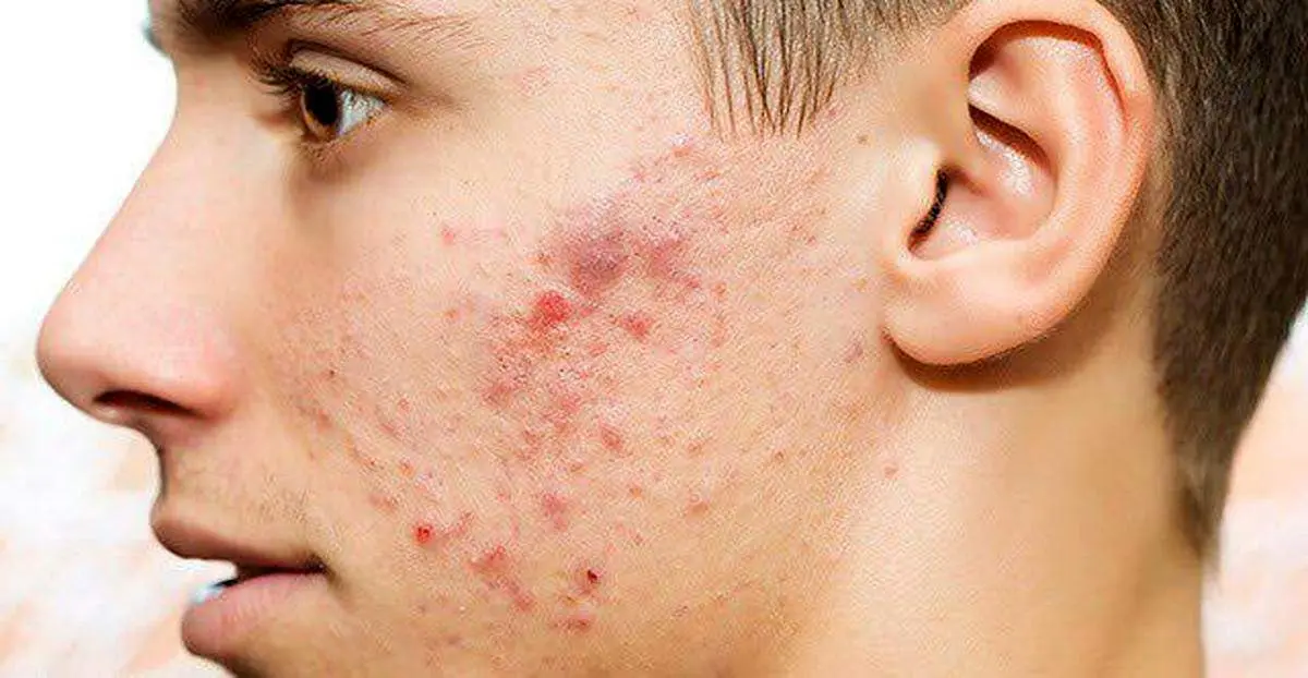 چه کنیم جوش نزنیم؟