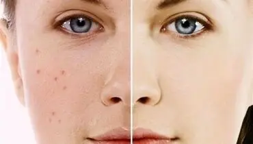 معجزه روغن دنبه برای پوست