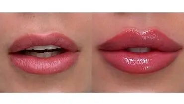 بهترین برند برای تزریق ژل لب