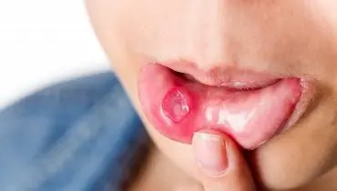 بهترین درمان برای آفت دهان و زبان