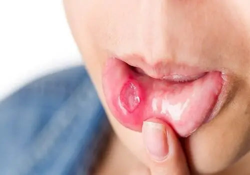 ۵ راهکار ساده برای تسکین درد آفت دهان و تسریع روند بهبود آن