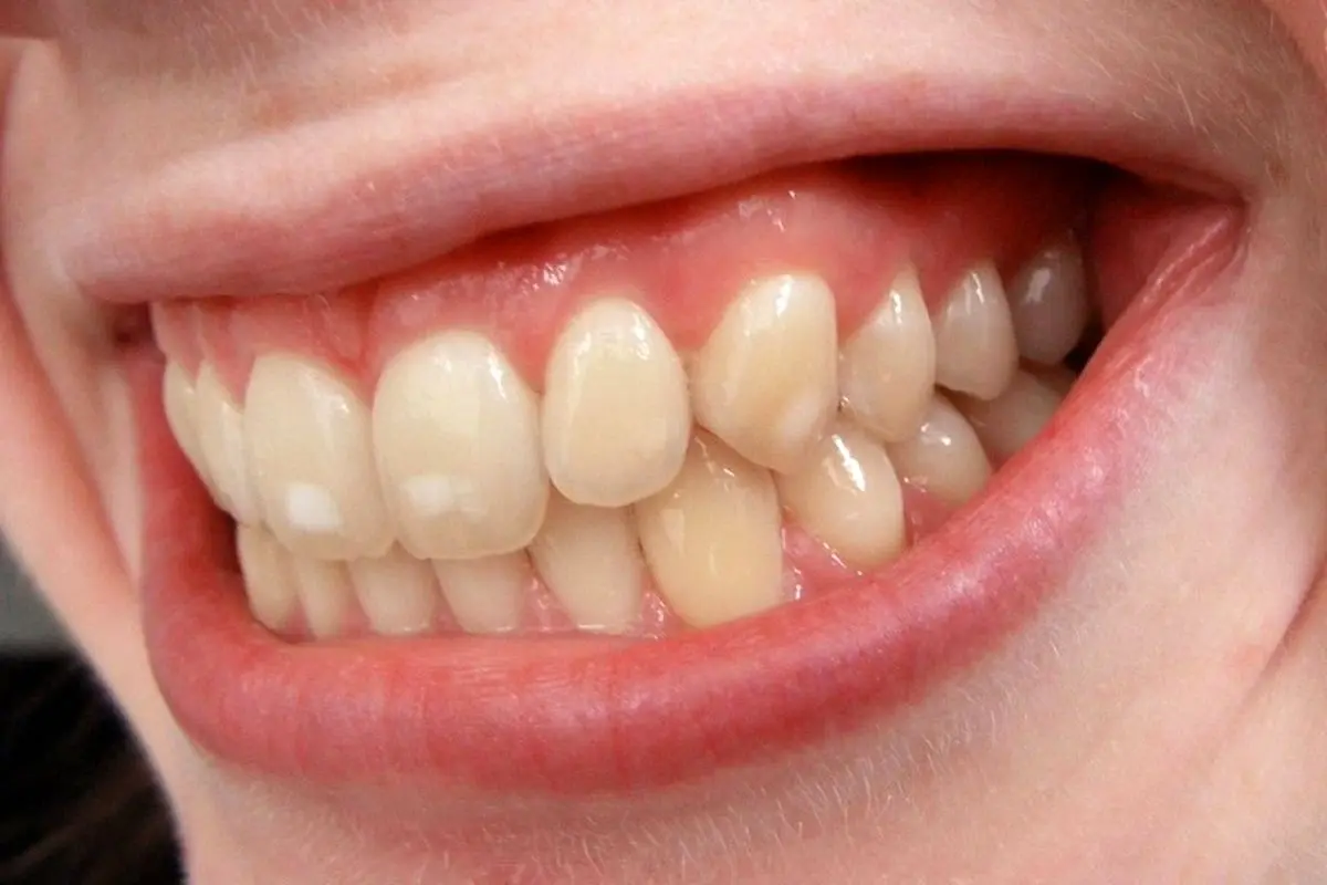 علت لکه های سفید روی دندان+ درمان