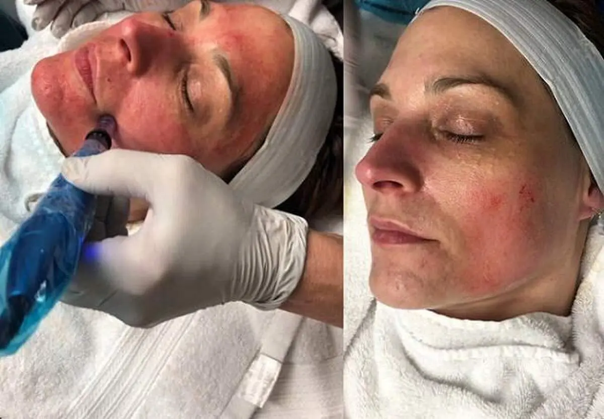 صفر تا صد آنچه از میکرونیدلینگ نمی دانید