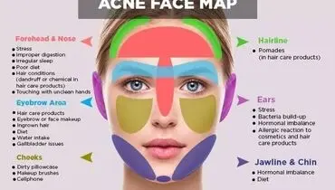 جوش زدن در هر قسمت از صورت نشانه چیست؟