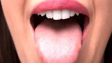 این علائم در دهان خبر از سرطان می دهند