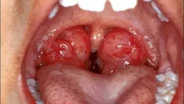 چه زمانی باید لوزه سوم را جراحی کنیم؟