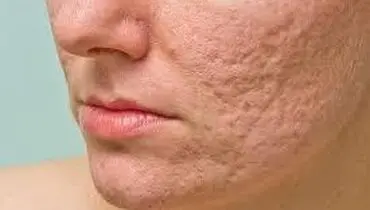 جلوگیری از آکنه با اجتناب از مصرف برخی مواد غذایی