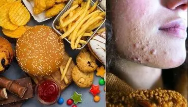 چه غذاهایی باعث جوش صورت می شود؟