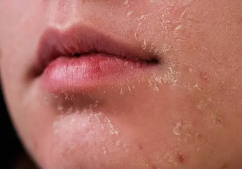 چگونه از خشکی پوست در زمستان جلوگیری کنیم؟