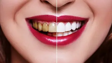 چرا دندان تغییر رنگ می دهد؟