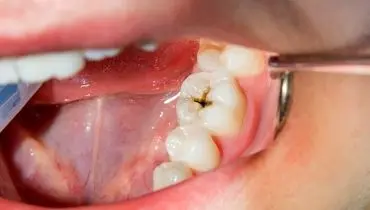 چگونه کرم خوردگی دندان را درمان کنیم؟