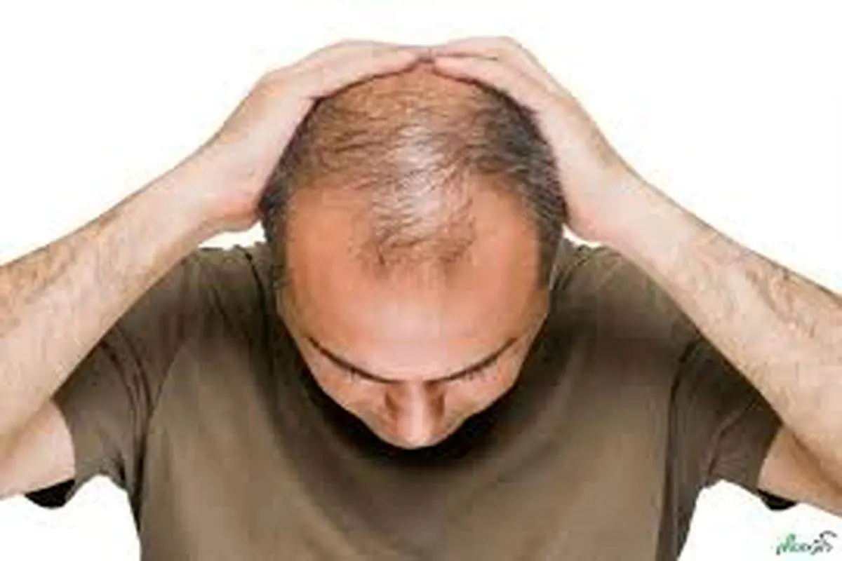 برای درمان ریزش موی سر در مردان چه کنیم؟