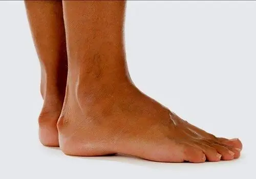 اصلی ترین علت های درد پاشنه پا و بهترین روش درمان چیست؟ 