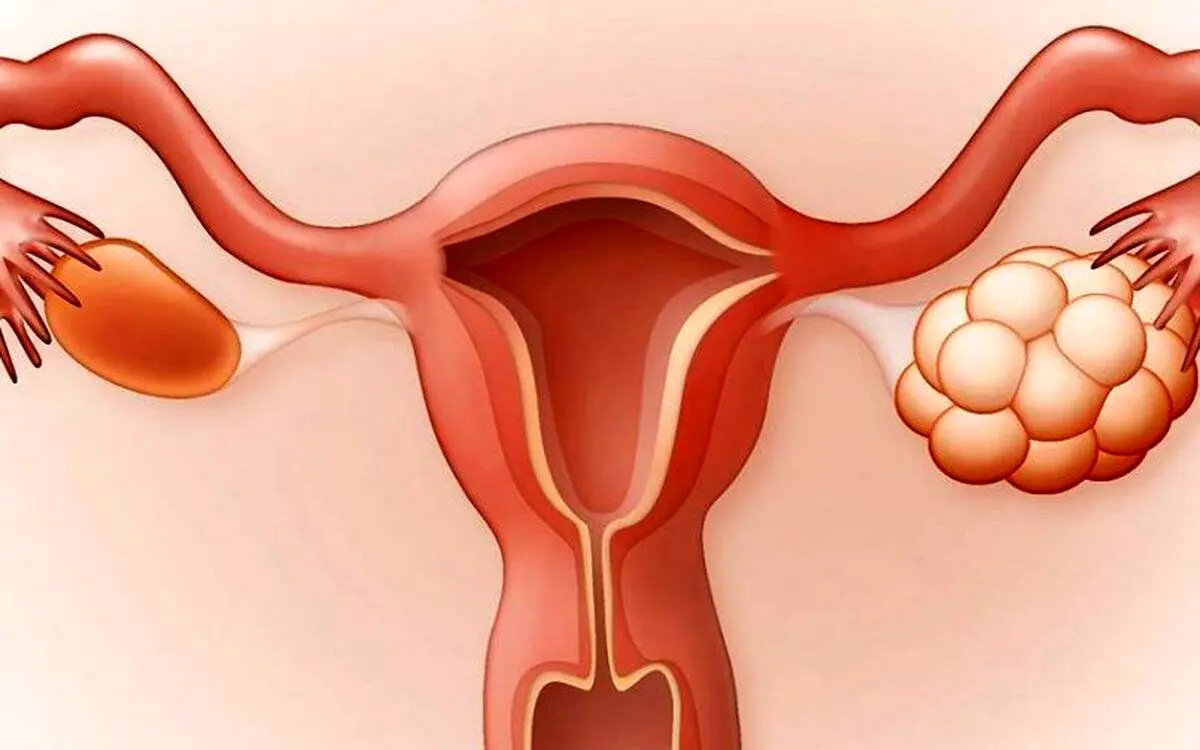 چگونه تنبلی تخمدان را درمان کنیم؟