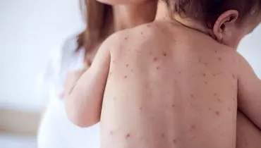 زنگ خطر به صدا درآمد ؛ آمار ابتلا به سرخک صعودی شد