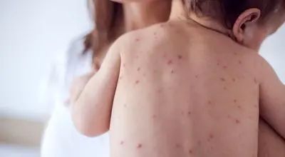 زنگ خطر به صدا درآمد ؛ آمار ابتلا به سرخک صعودی شد