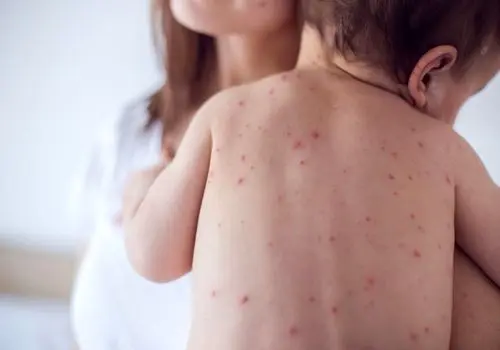 زنگ خطر به صدا درآمد ؛ آمار ابتلا به سرخک صعودی شد