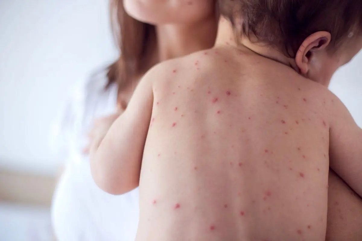 زنگ خطر به صدا درآمد ؛ آمار ابتلا به سرخک صعودی شد
