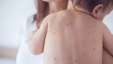 زنگ خطر به صدا درآمد ؛ آمار ابتلا به سرخک صعودی شد