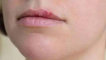 ترفند رهایی از شر تبخال