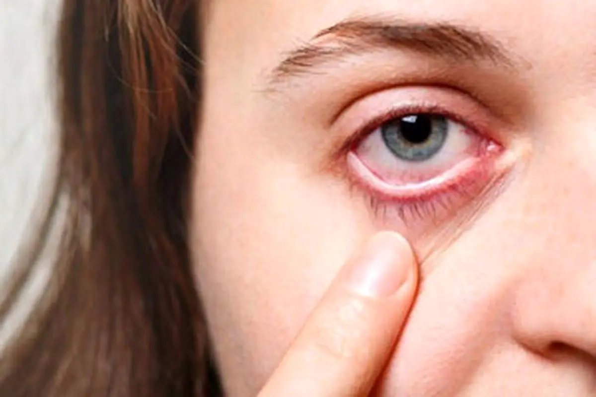 چشم هم سکته میکند؟
