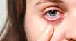 چشم هم سکته می‌کند؟