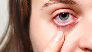 چشم هم سکته می‌کند؟
