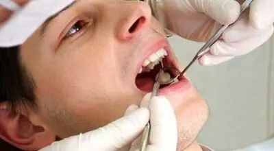 سیگار بعد از ایمپلنت دندان چه عوارضی دارد؟