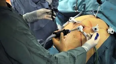 چه افرادی کاندیدای جراحی چاقی هستند؟ 
