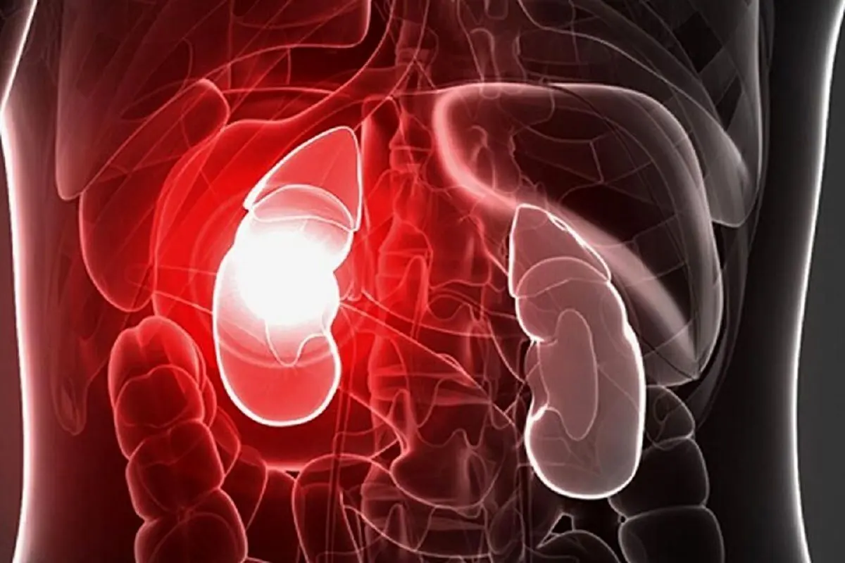 ساده ترین راهکار درمان سنگ کلیه