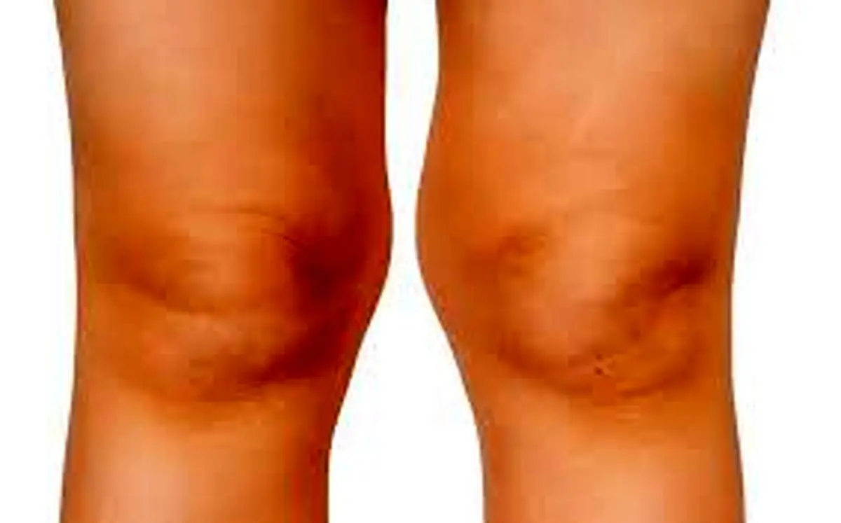  زانوی ضربدری چیست ؟