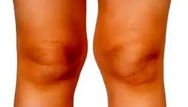  زانوی ضربدری چیست ؟