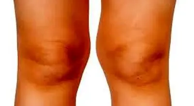  زانوی ضربدری چیست ؟