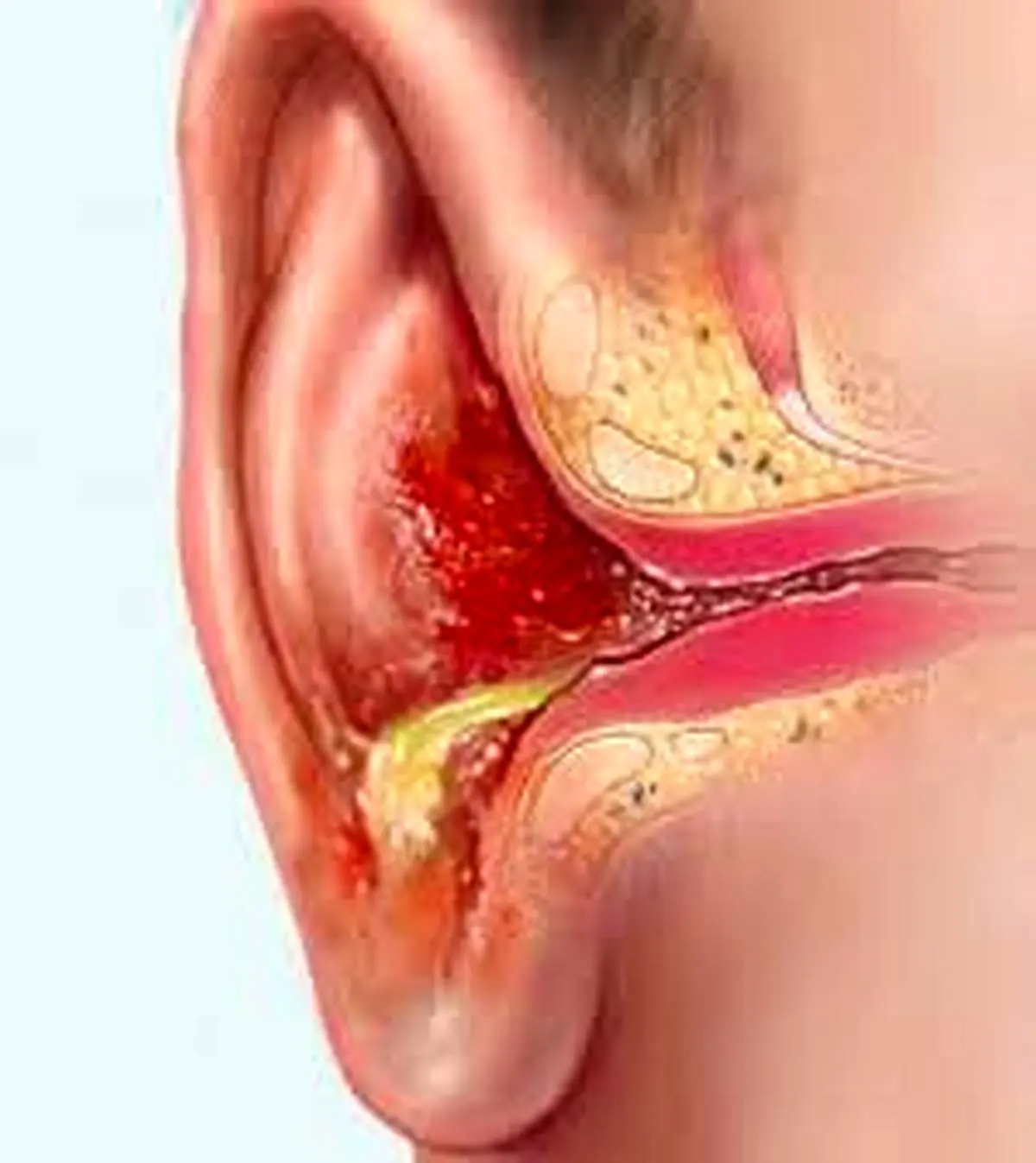 دلایل تجمع مایع پشت پرده گوش
