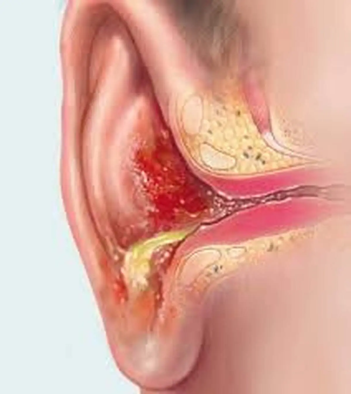 دلایل تجمع مایع پشت پرده گوش
