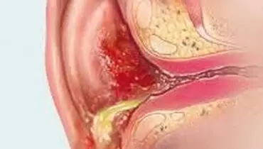 دلایل تجمع مایع پشت پرده گوش

