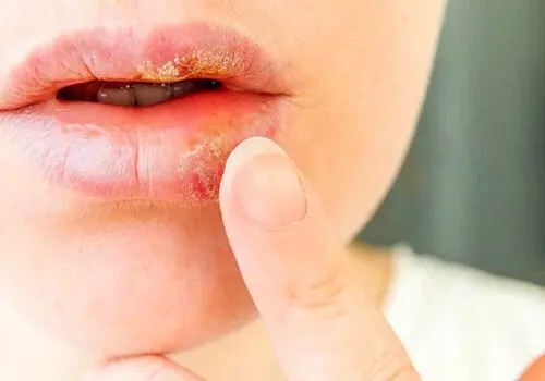 چرا باید HPV را جدی بگیریم؟