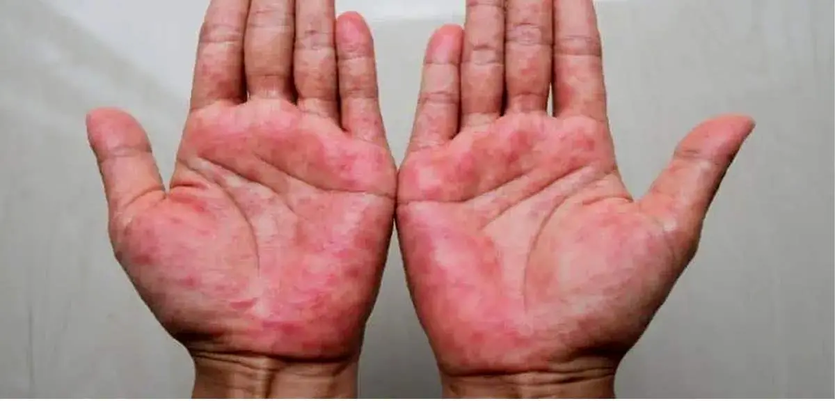 ارتباط تغذیه با اگزما؛ خوراکی‌های کمک‌کننده و عوامل تشدیدکننده