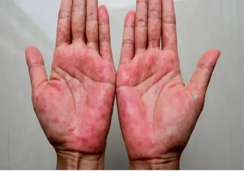 ارتباط تغذیه با اگزما؛ خوراکی‌های کمک‌کننده و عوامل تشدیدکننده