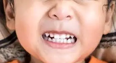 دندان‌قروچه در خواب نشانه چیست؟
