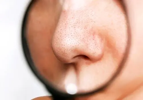 چه خوراک‌هایی باعث تشدید آکنه صورت می‌‌شوند؟
