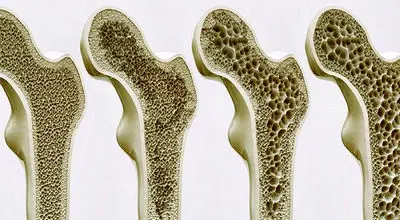 راه حل جدید‌ برای درمان پوکی استخوان
