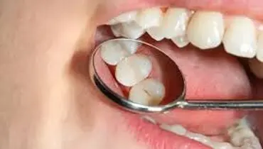 علت پوسیدگی دندان چیست؟
