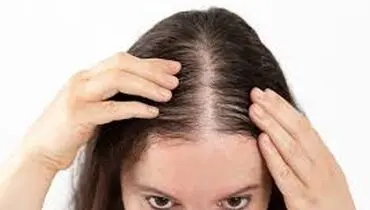 چرا موها می‌ریزند؟ دلایل شایع ریزش مو