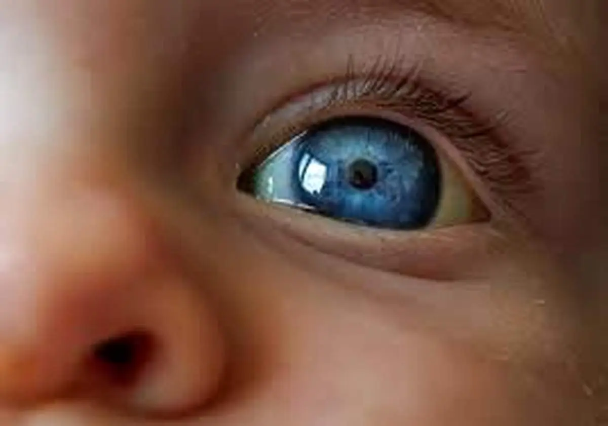 چرا چشمان نوزاد زرد است؟
